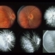 Eales Disease Eales Disease